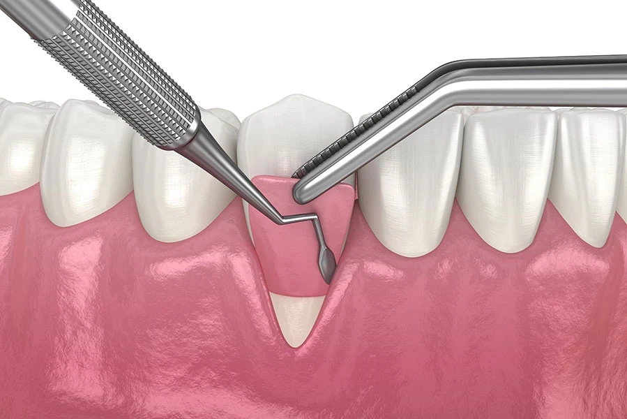 Gum Grafting in Toronto | Bloor-Yorkville Periodontics