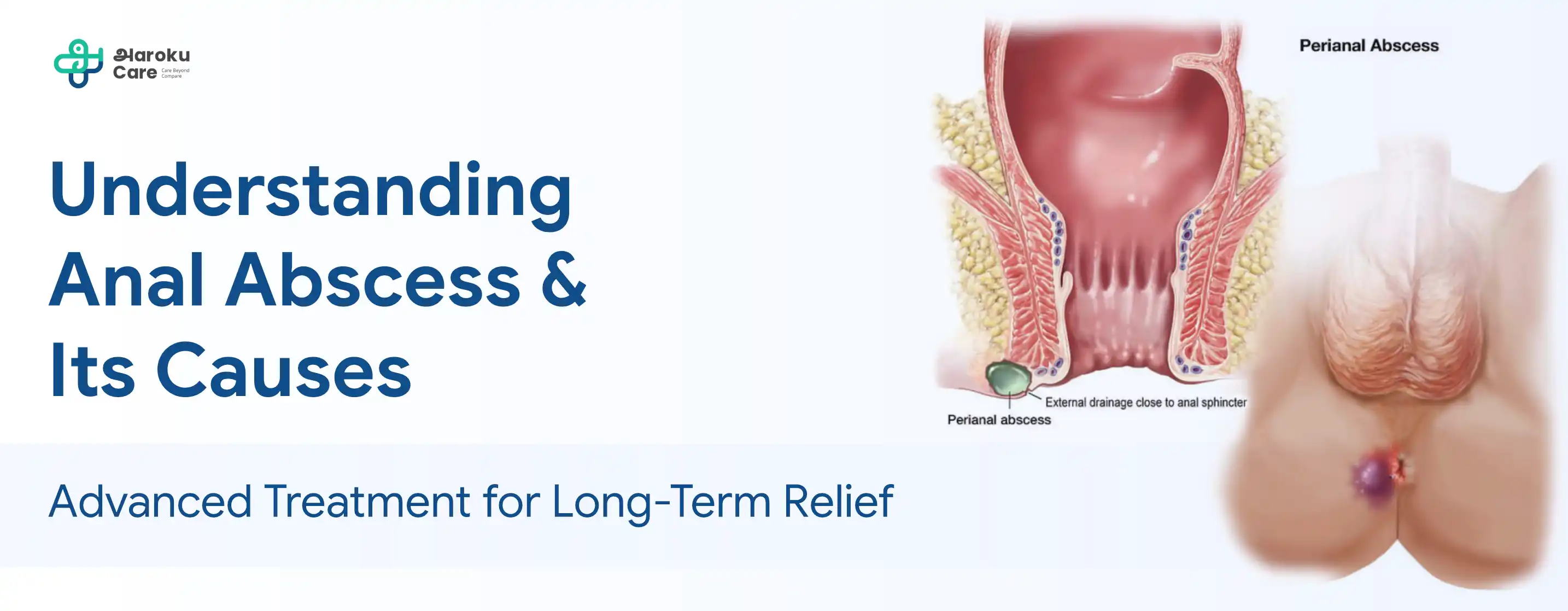 Understanding Anal Abscess & Its Causes