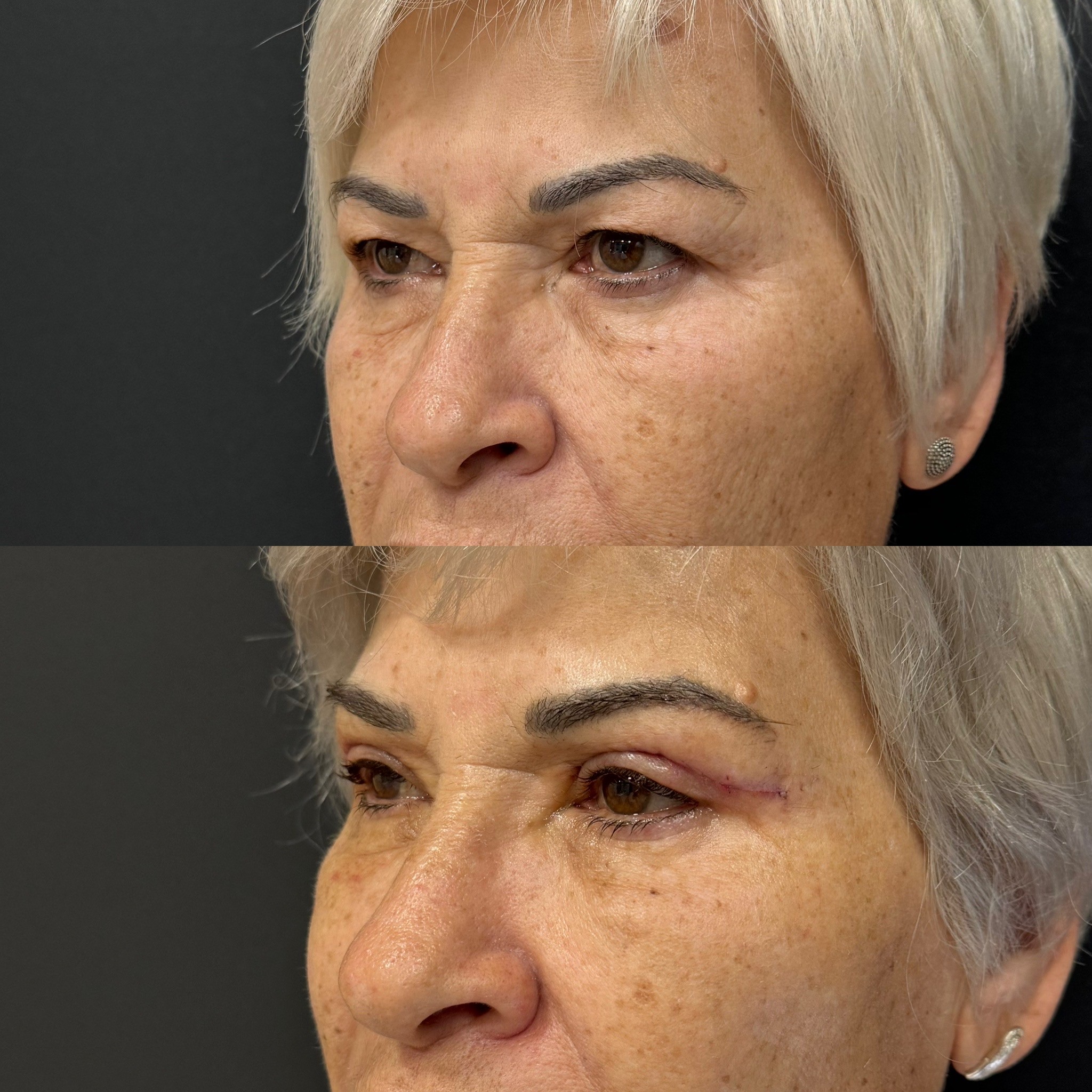 6 days upper blepharoplasty result left oblique view