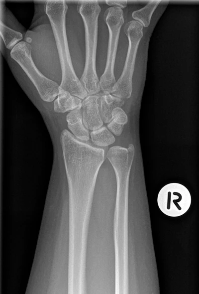 Wrist trauma: X-ray interpretation