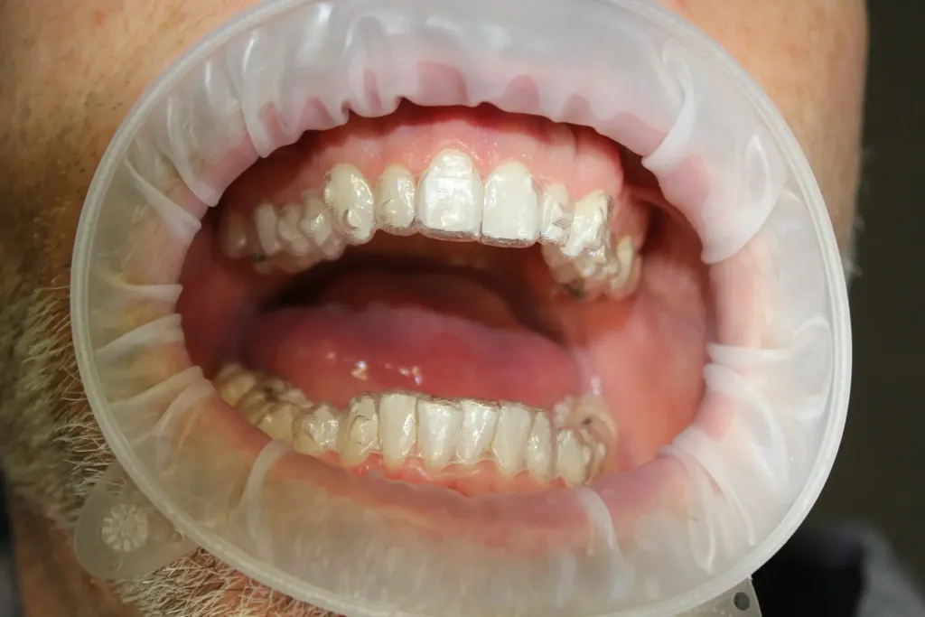 Tips for Preventing Tooth Sensitivity