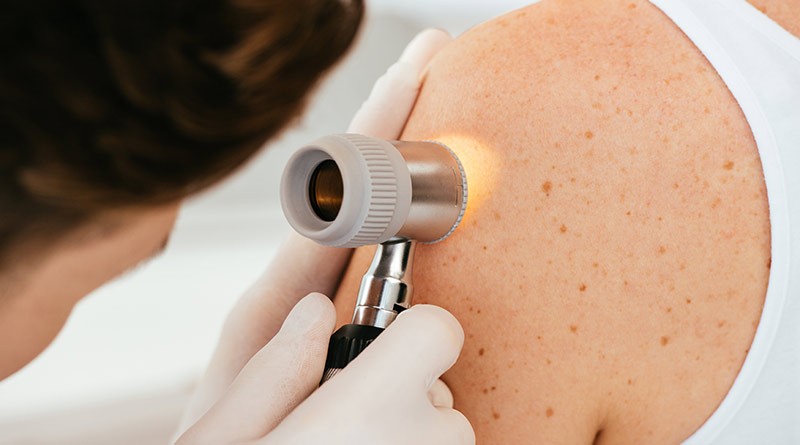 Professionnel de santé praticant une analyse avec un dermatoscope