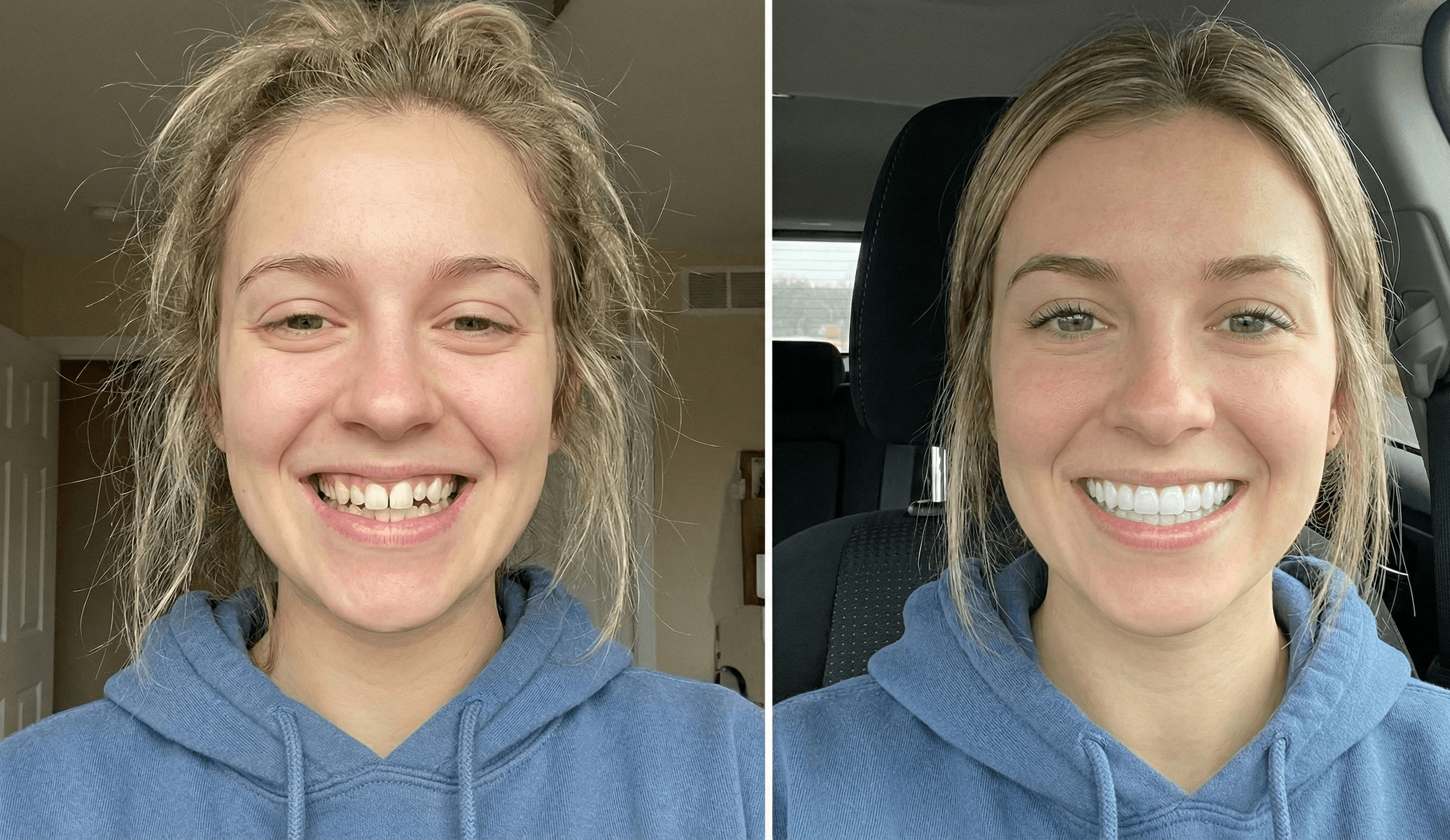 Close-up of woman smiling with bright white teeth showcasing results of cosmetic dentistry