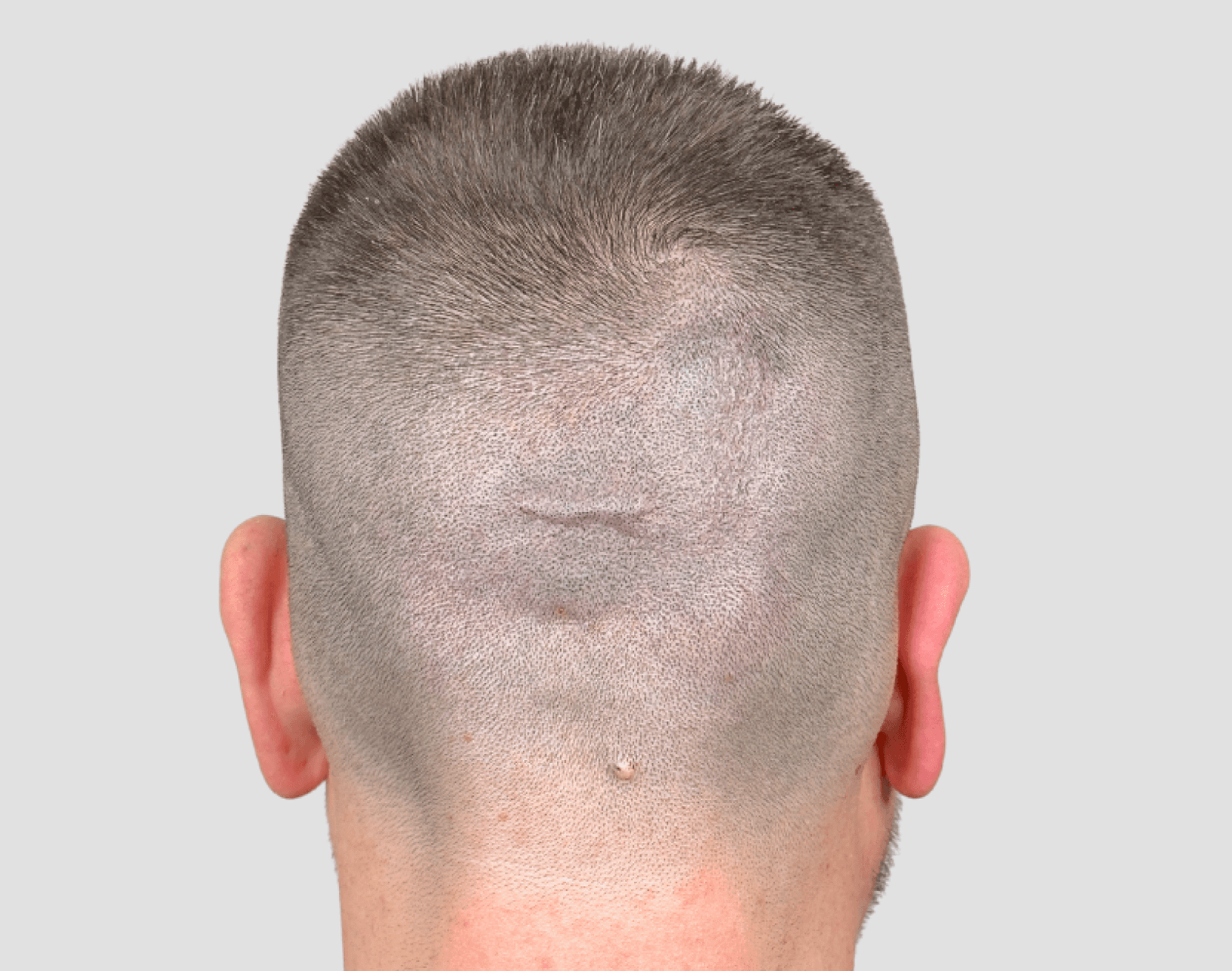 Scalp & Brows, Skalp Mikropigmentering i Stockholm