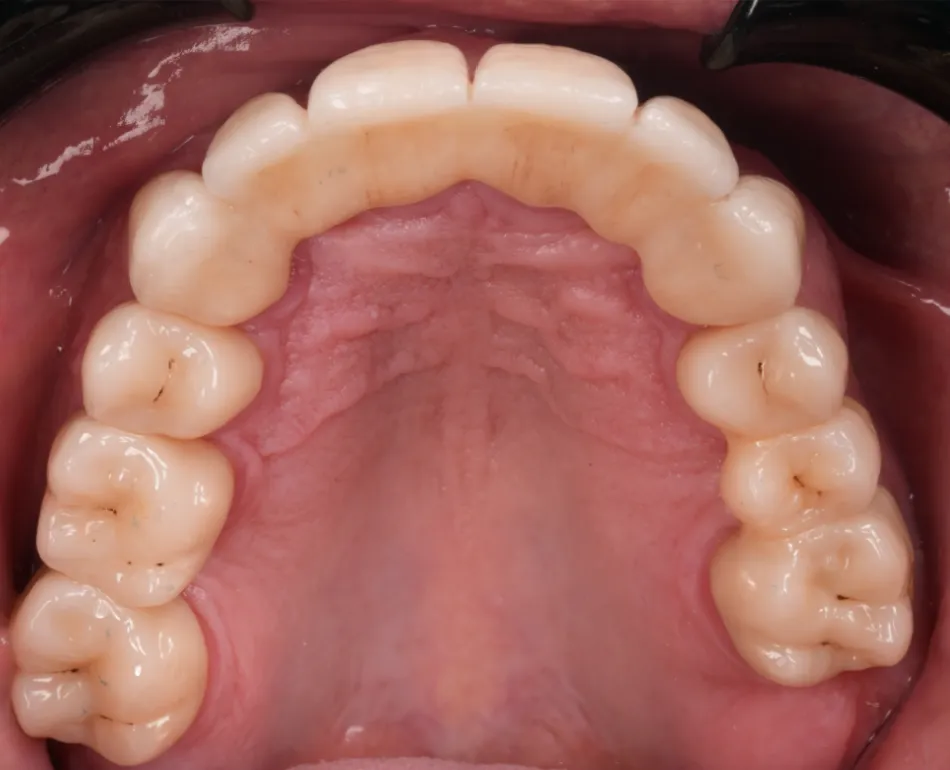 After prosthetic rehabilitation