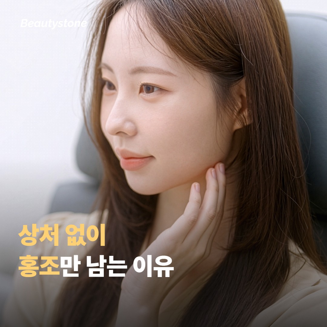 인모드 FX는 왜 상처 없이 홍조만 남을까요