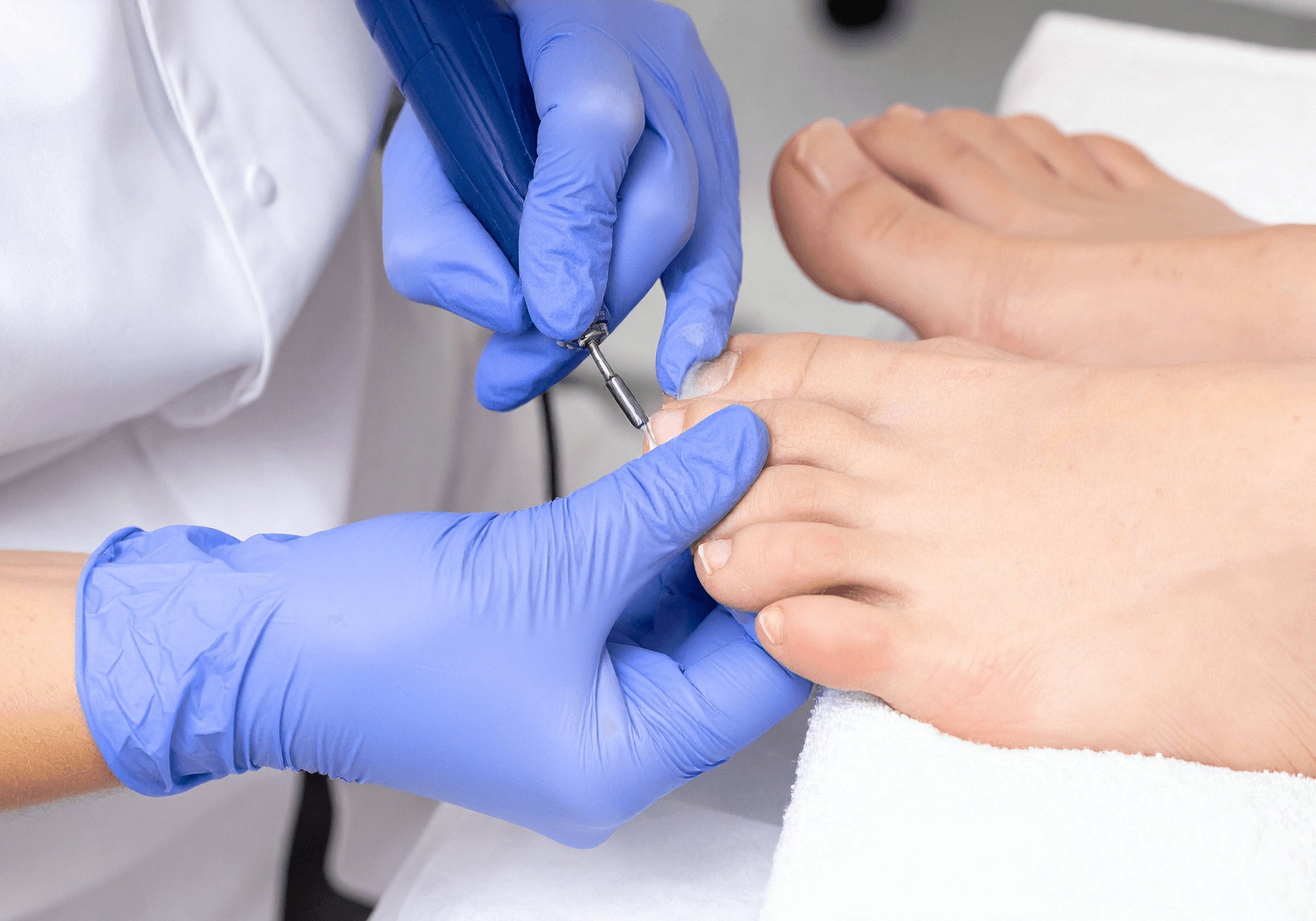 Fungal nail