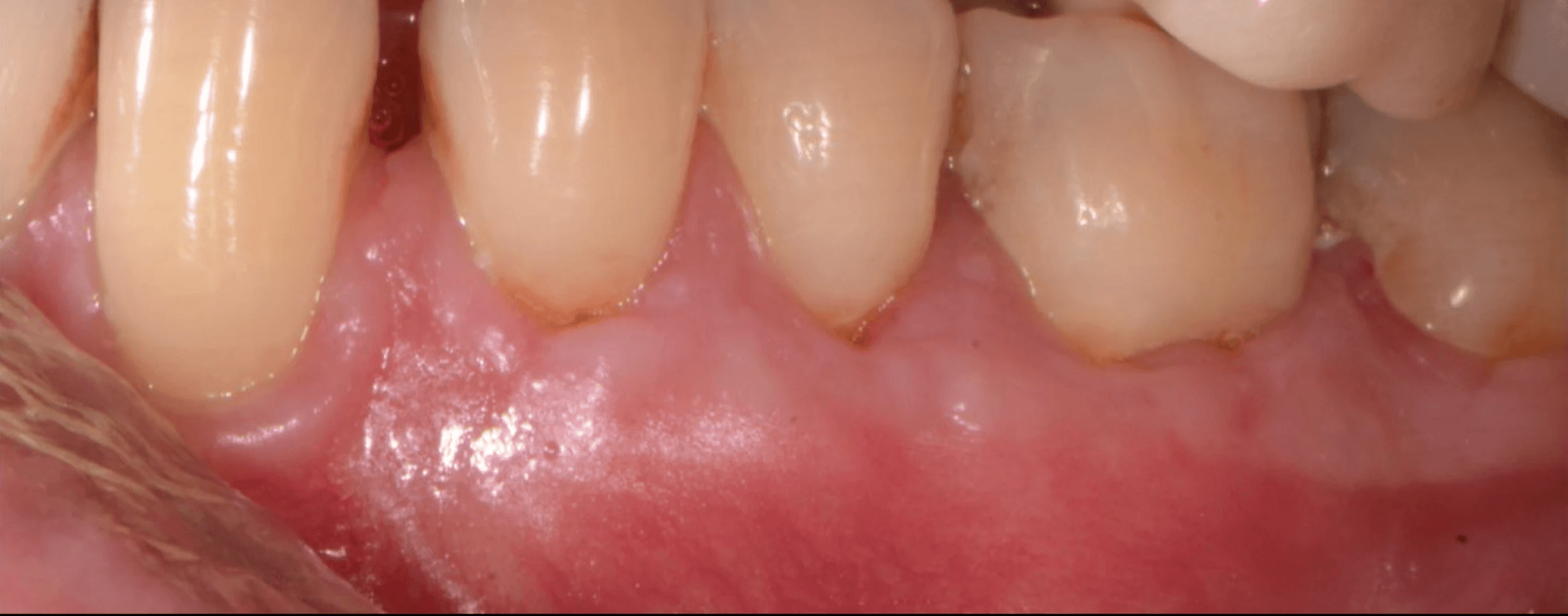 After removal of composite and restoration of the gumline with gingival grafting at Bloor-Yorkville Periodontics. Gums much healthier and healing well.