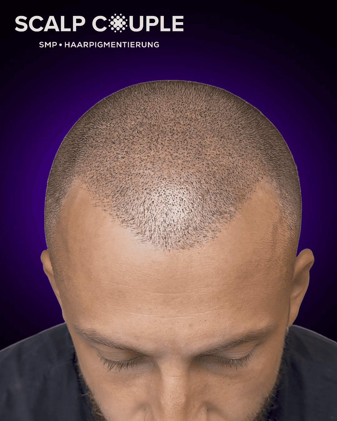 Haarpigmentierung Männer Vorher Nachher – SMP Ergebnis | Scalp Couple
