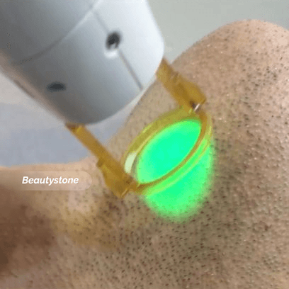 How Folliculitis Develops After Beard Laser Hair Removal