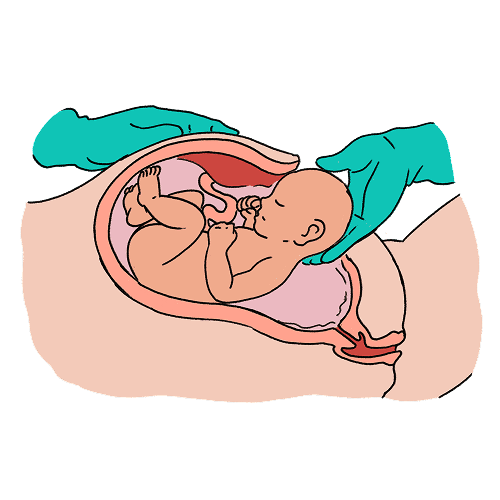 A cross-section illustration of a baby being guided out of the caesarean incision. The baby's head is at the incision opening, it is being guided by a surgeon's gloved hand while their other hand is holding the rest of the belly.