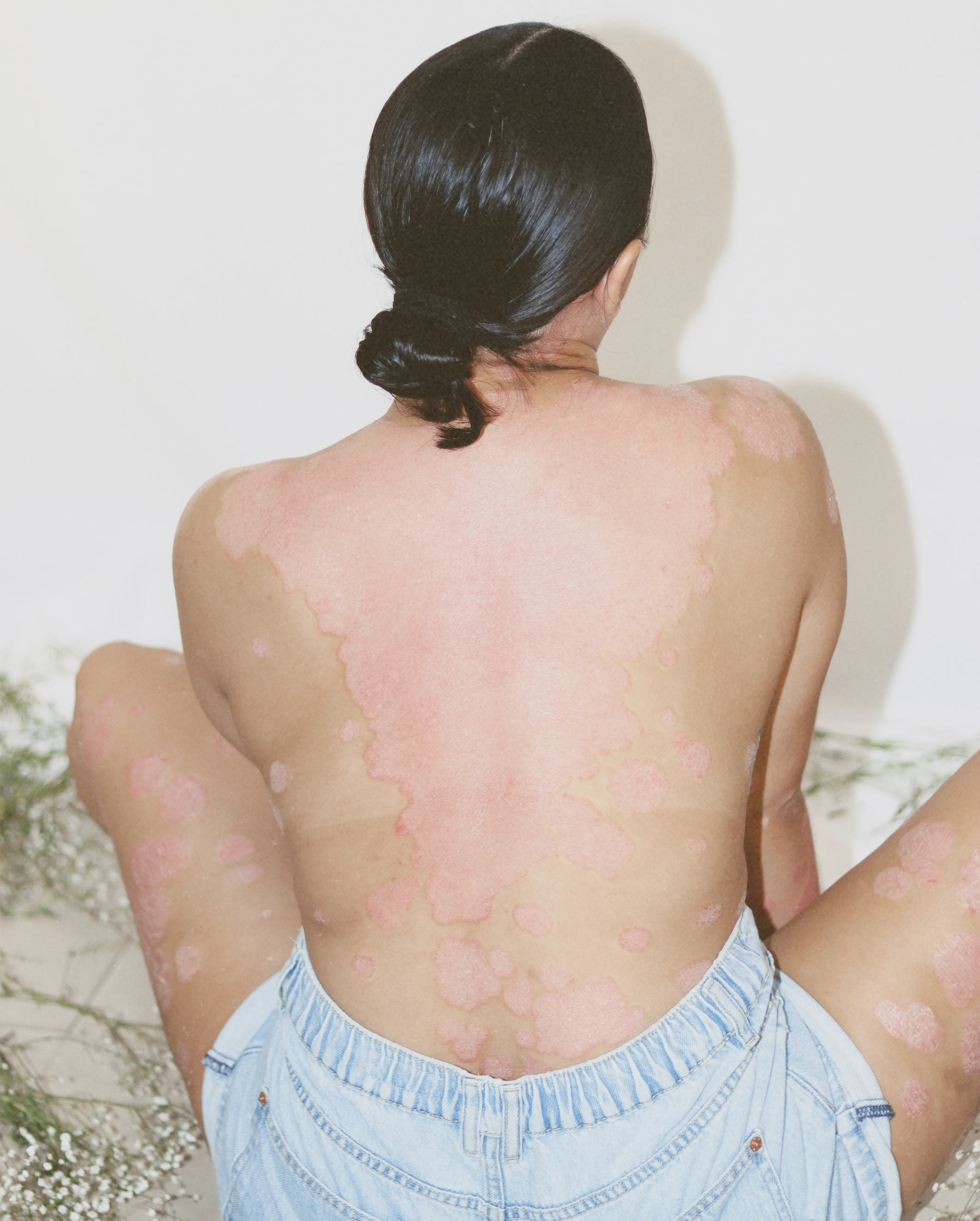 Mujer de espaldas mostrando su piel con psoriasis, en retrato artístico