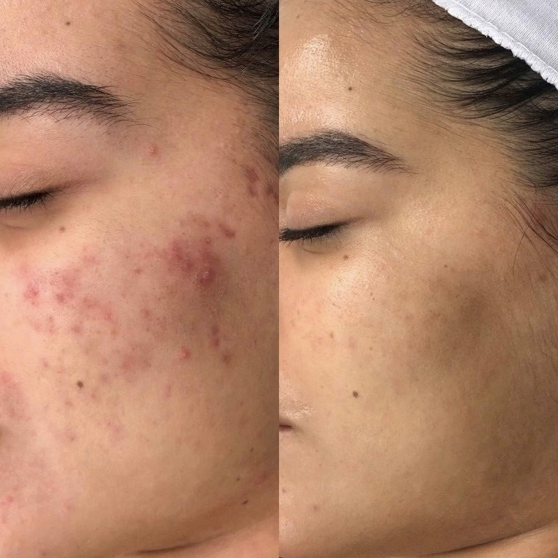 Before and after microneedling treatment in LA.