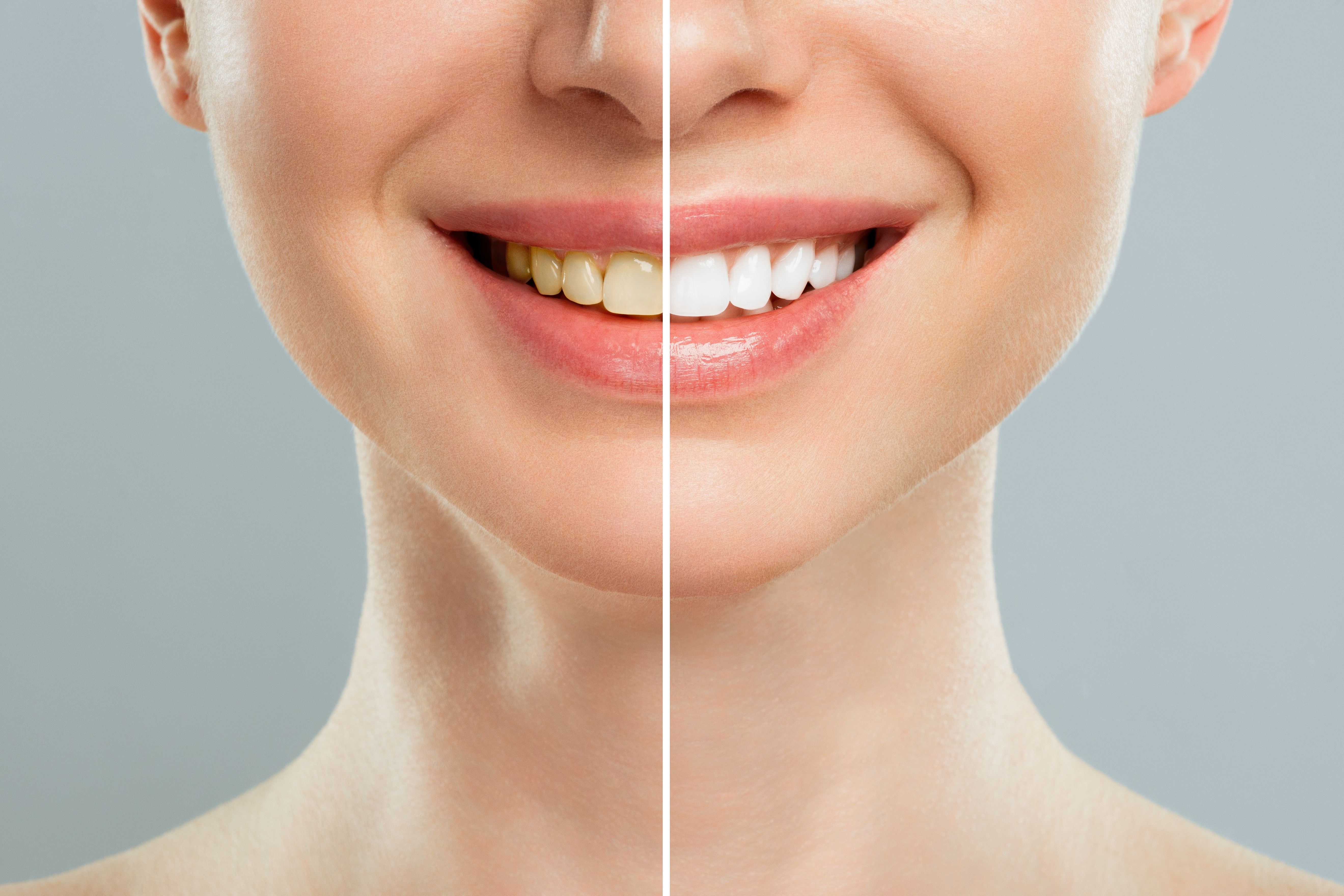 teeth_whitening