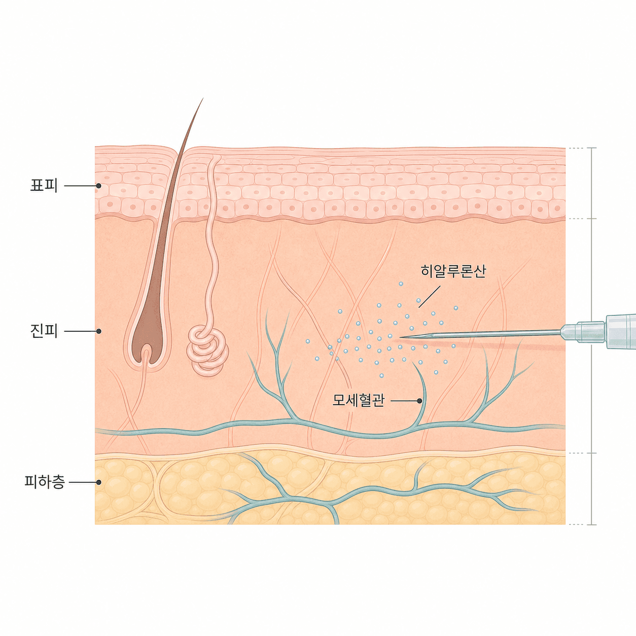 진피에 스킨부스터 성분이 주입되는 모습