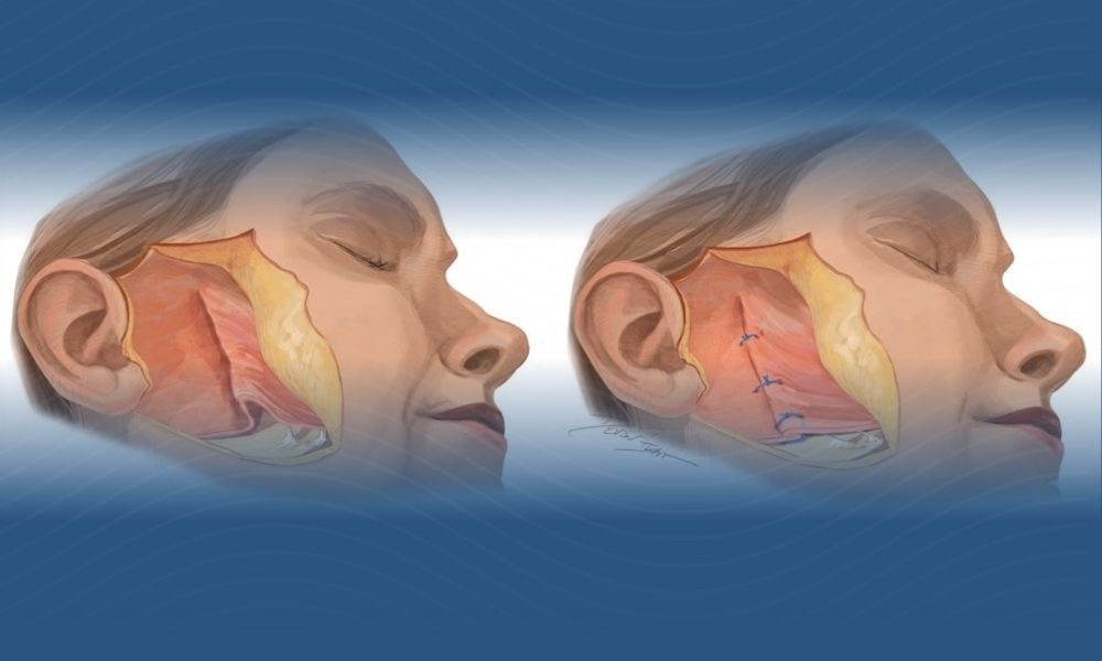 ilustração esquemática de dois rostos mostrando a técnica de deep plane lifting facial