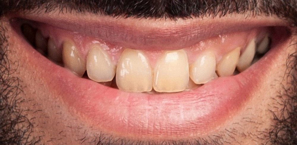 Fogászati esztétika előtte–utána – mosoly átalakítás