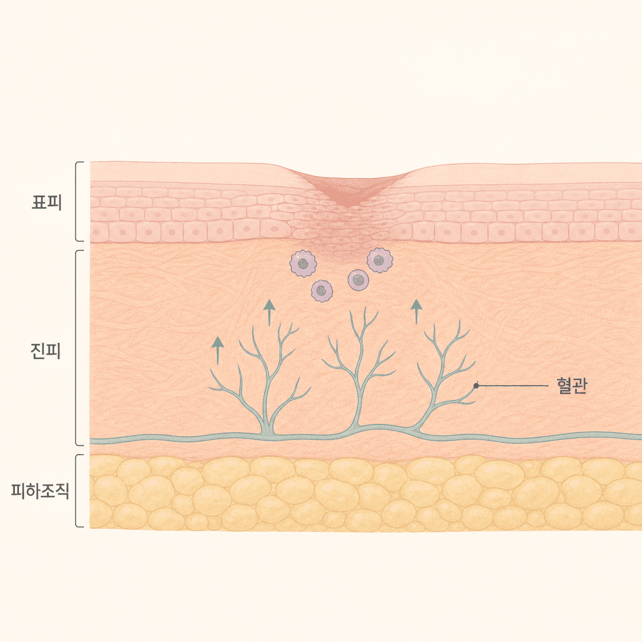 회복기에 새 혈관이 자라며 상처가 아무는 과정