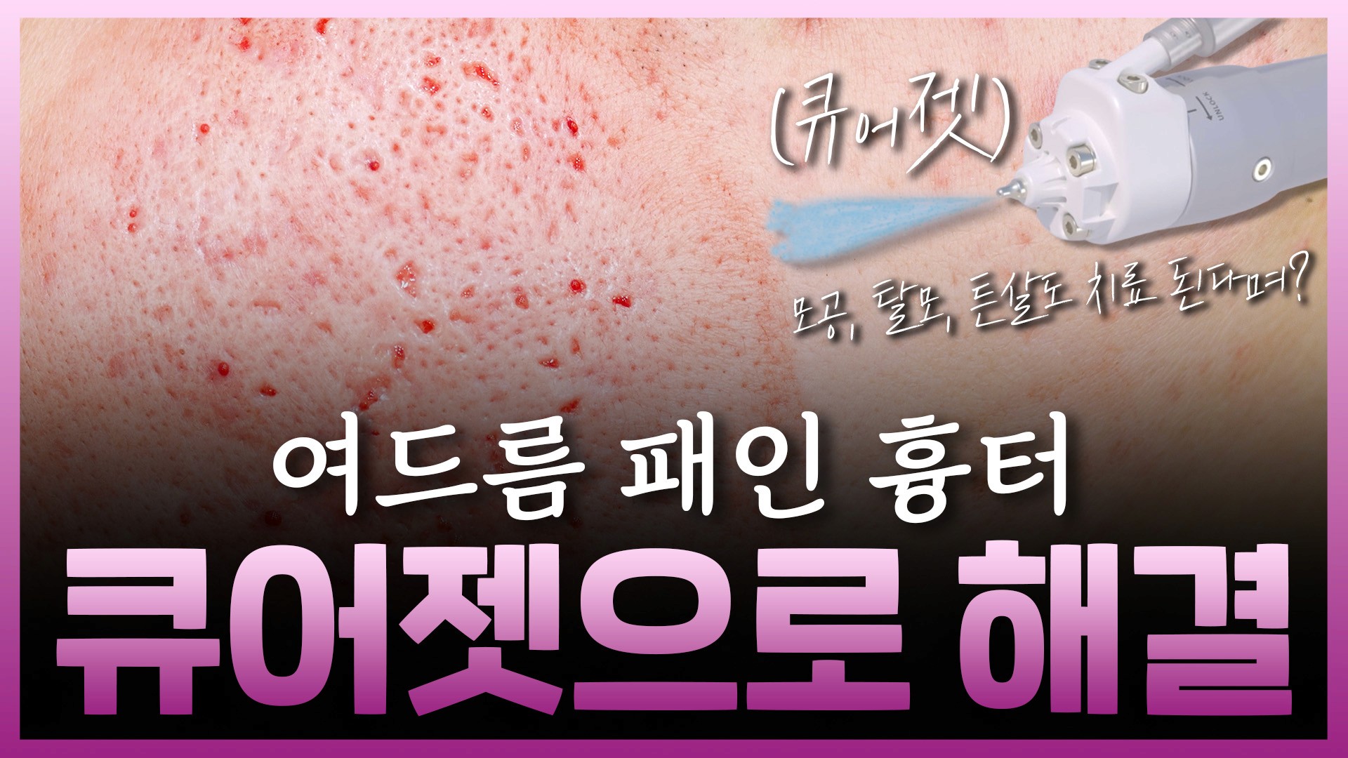 레이저와 큐어젯의 차이, 흉터 치료의 시너지를 만드는 법