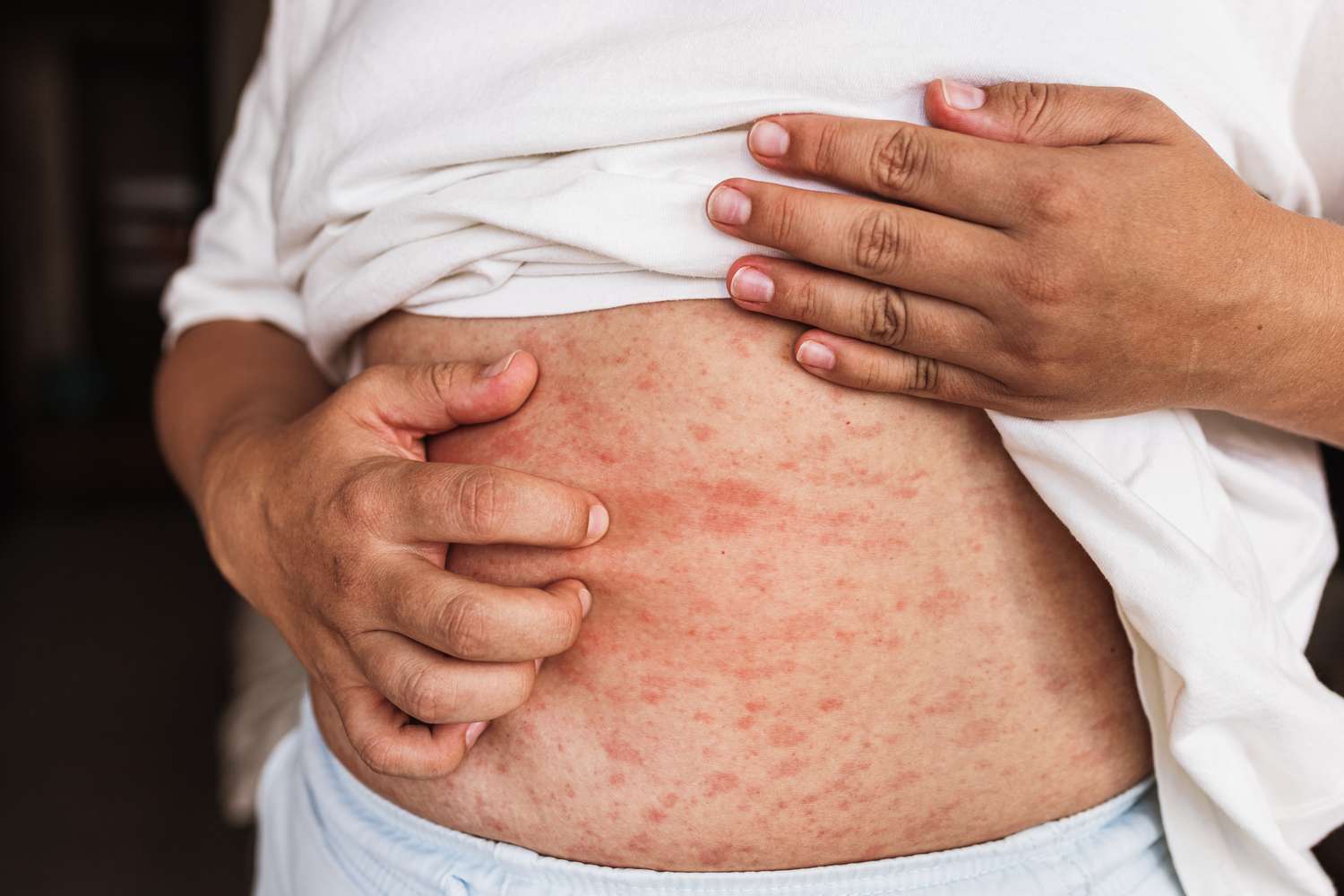 man with rash - Tirzepatide Rash