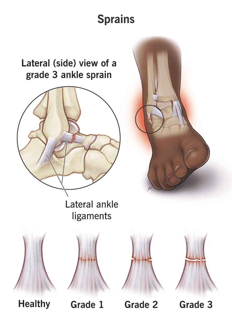 illustration of ankle sprain