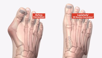 illustration of Lapiplasty (Bunionectomy)