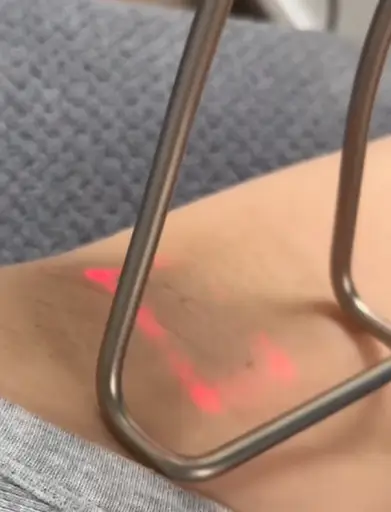Fotona laser hair removal wand targeting skin tissue.