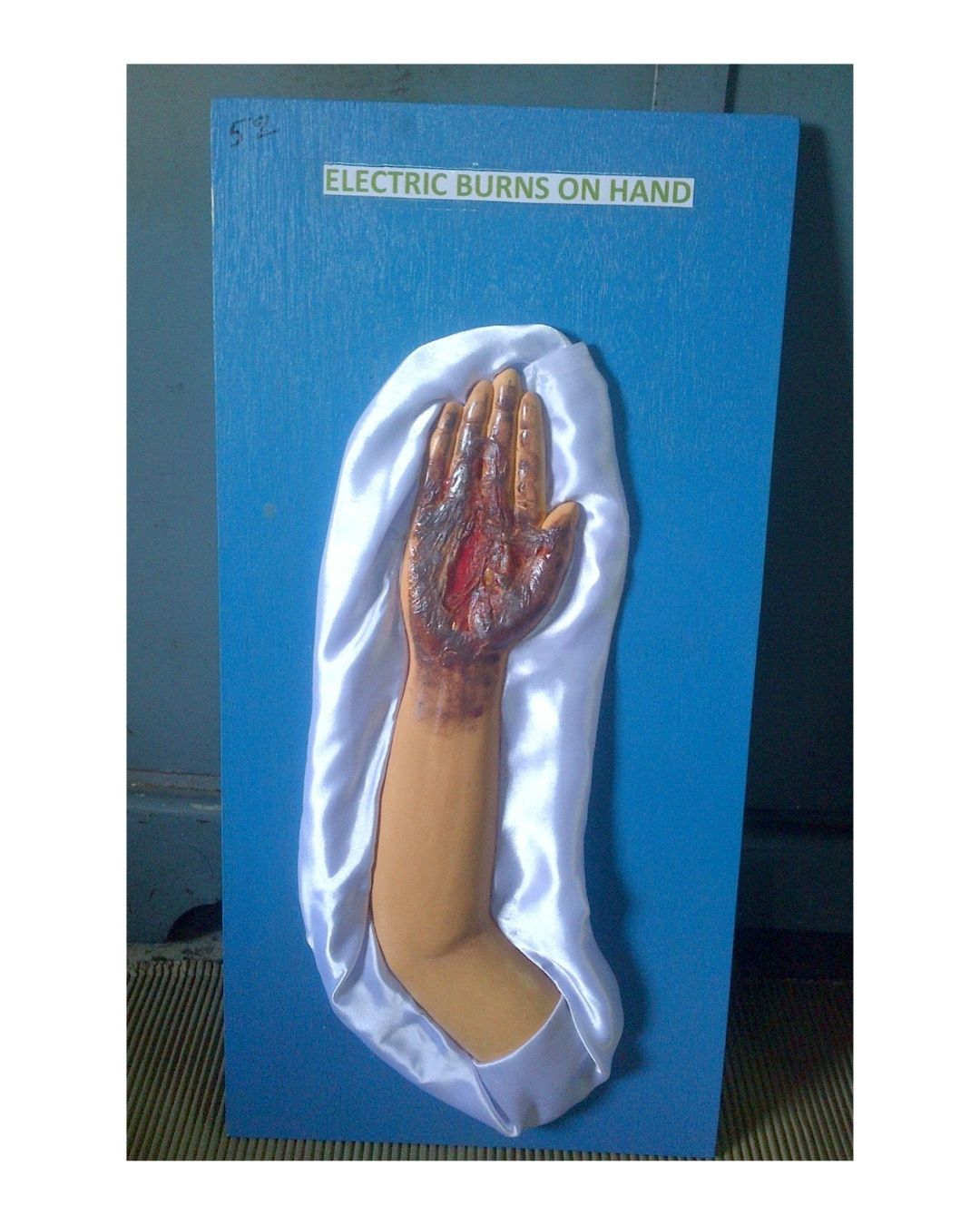 Electric Burns on Hand