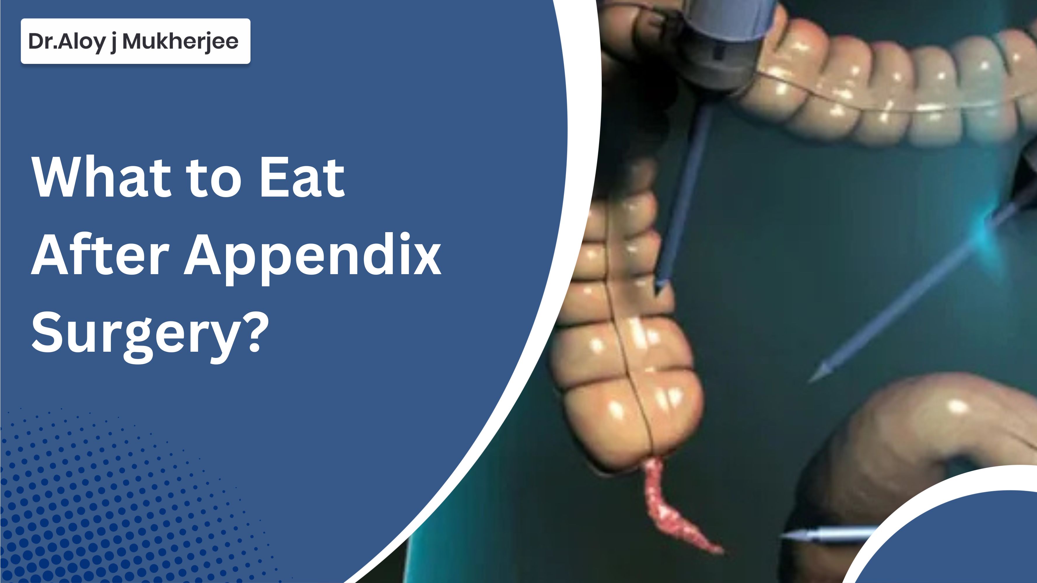 What to Eat After Appendix Surgery