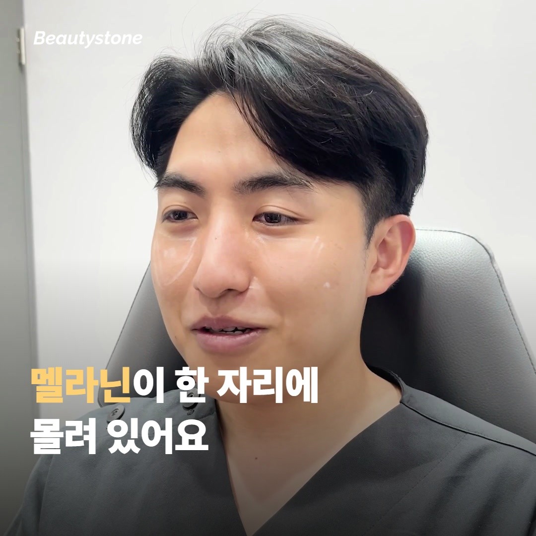 흑자가 자리잡은 곳은 멜라닌 밀도가 달라요