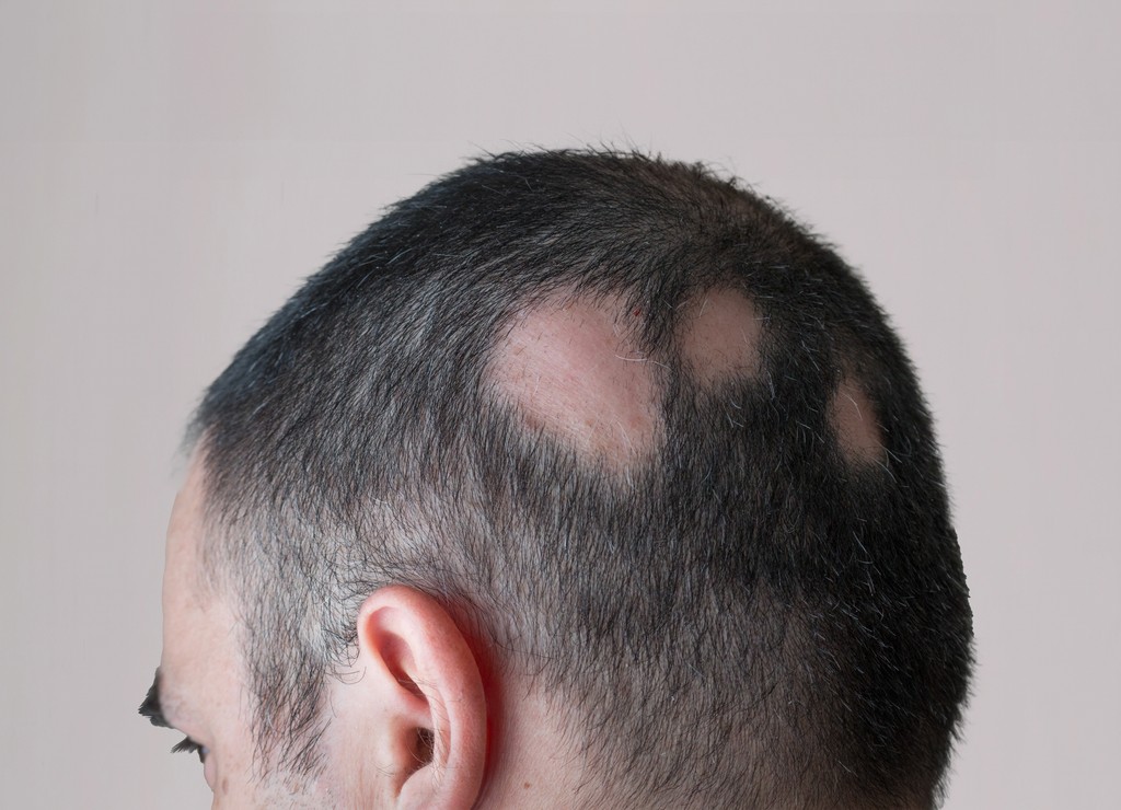 Alopecia Treatment