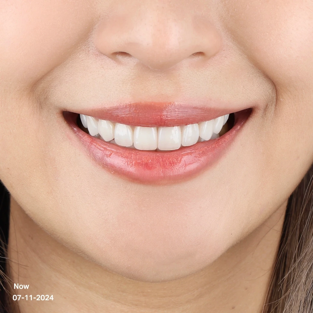 รีวิวออกแบบรอยยิ้มวีเนียร์ cosdent smile design