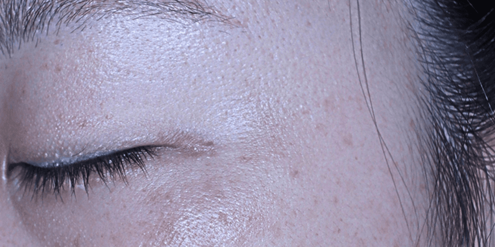 Pigmentation - After