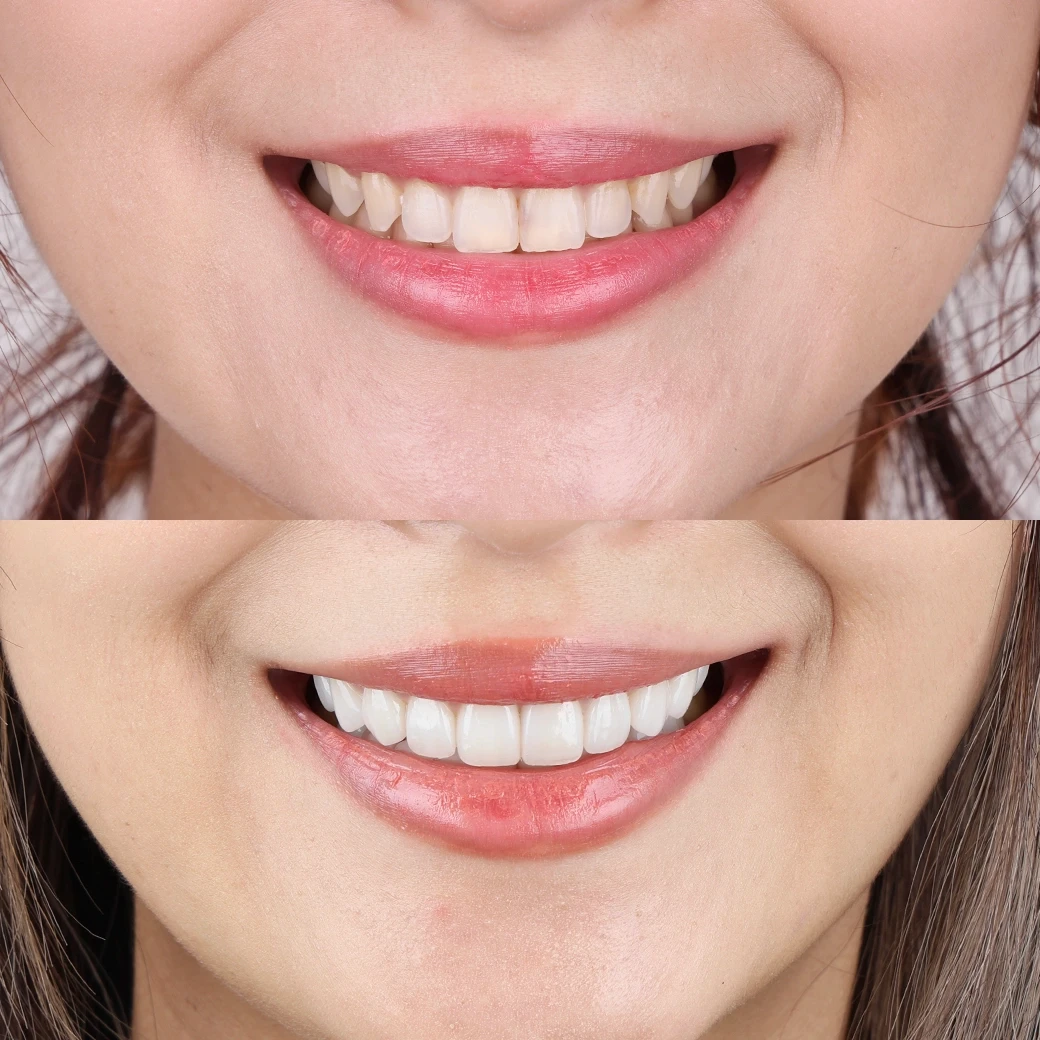 รีวิวออกแบบรอยยิ้มวีเนียร์ cosdent smile design