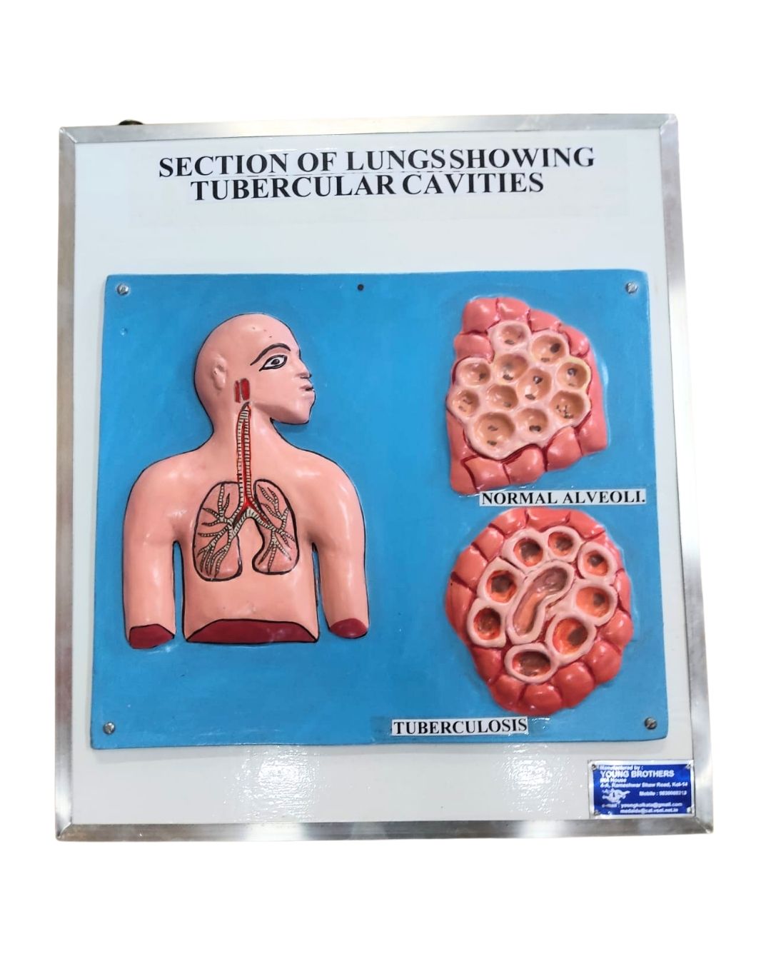 Tuberculosis Lung