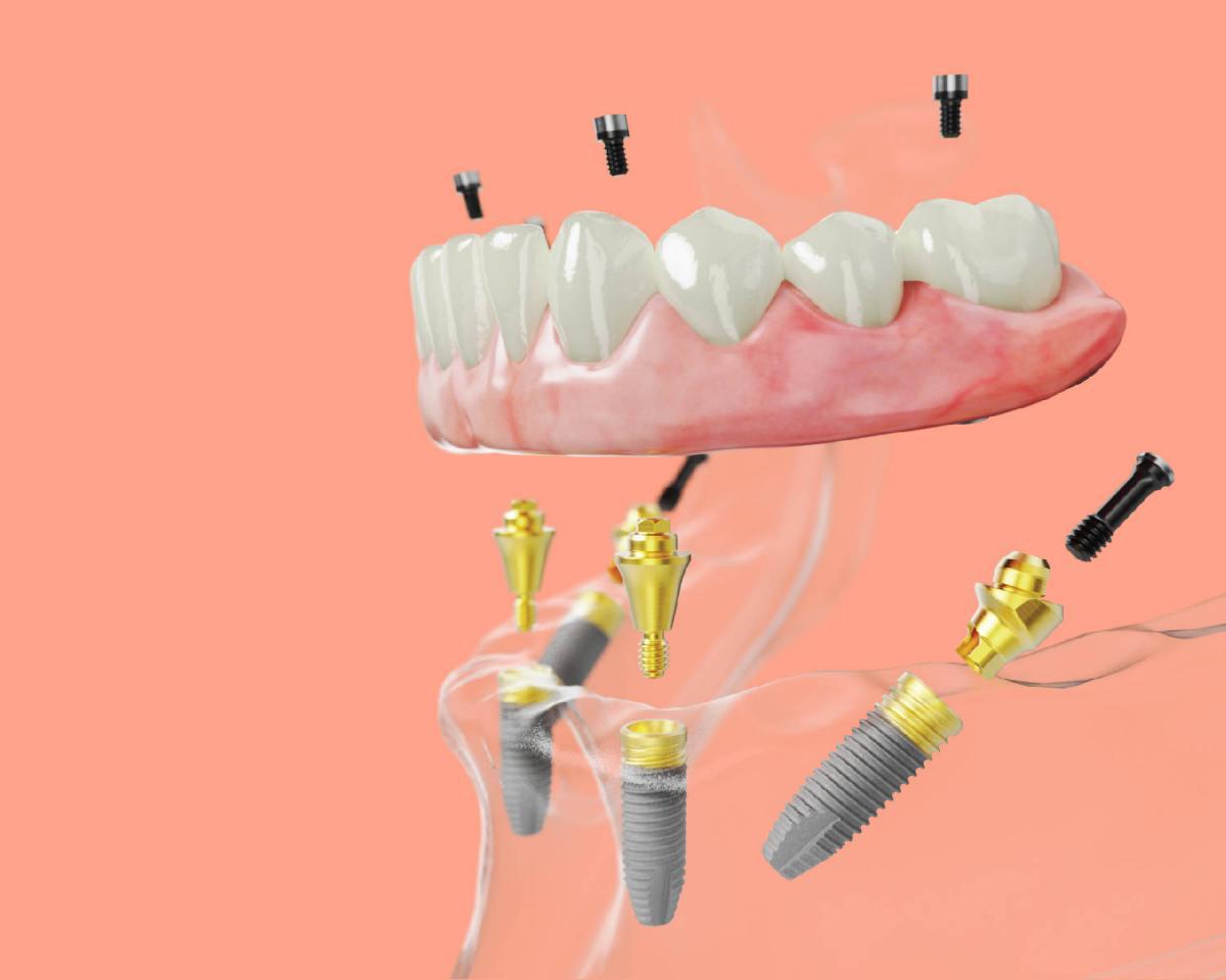 Teeth Implants