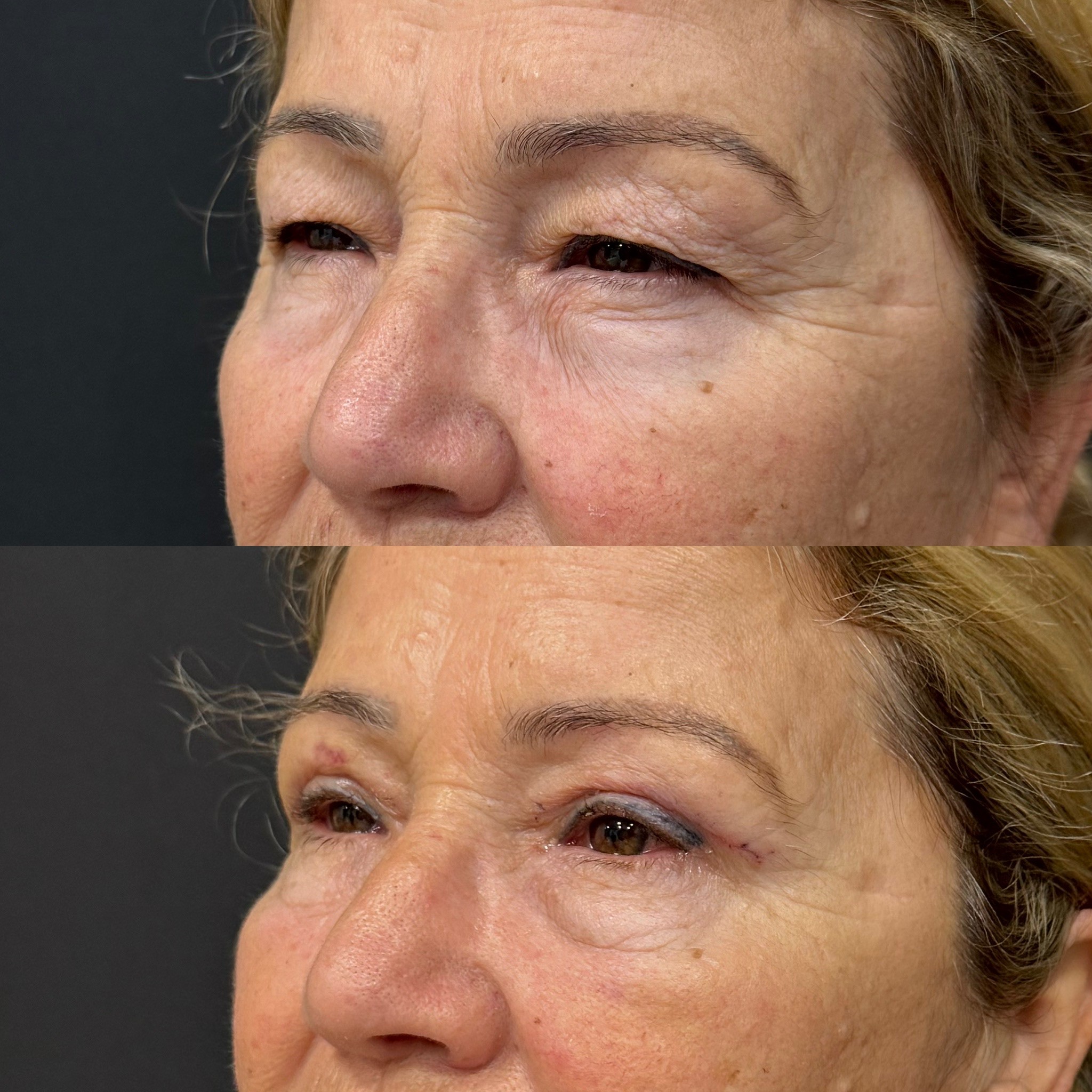 upper blepharoplasty surgery result before after photo 7 days post-surgery right oblique view