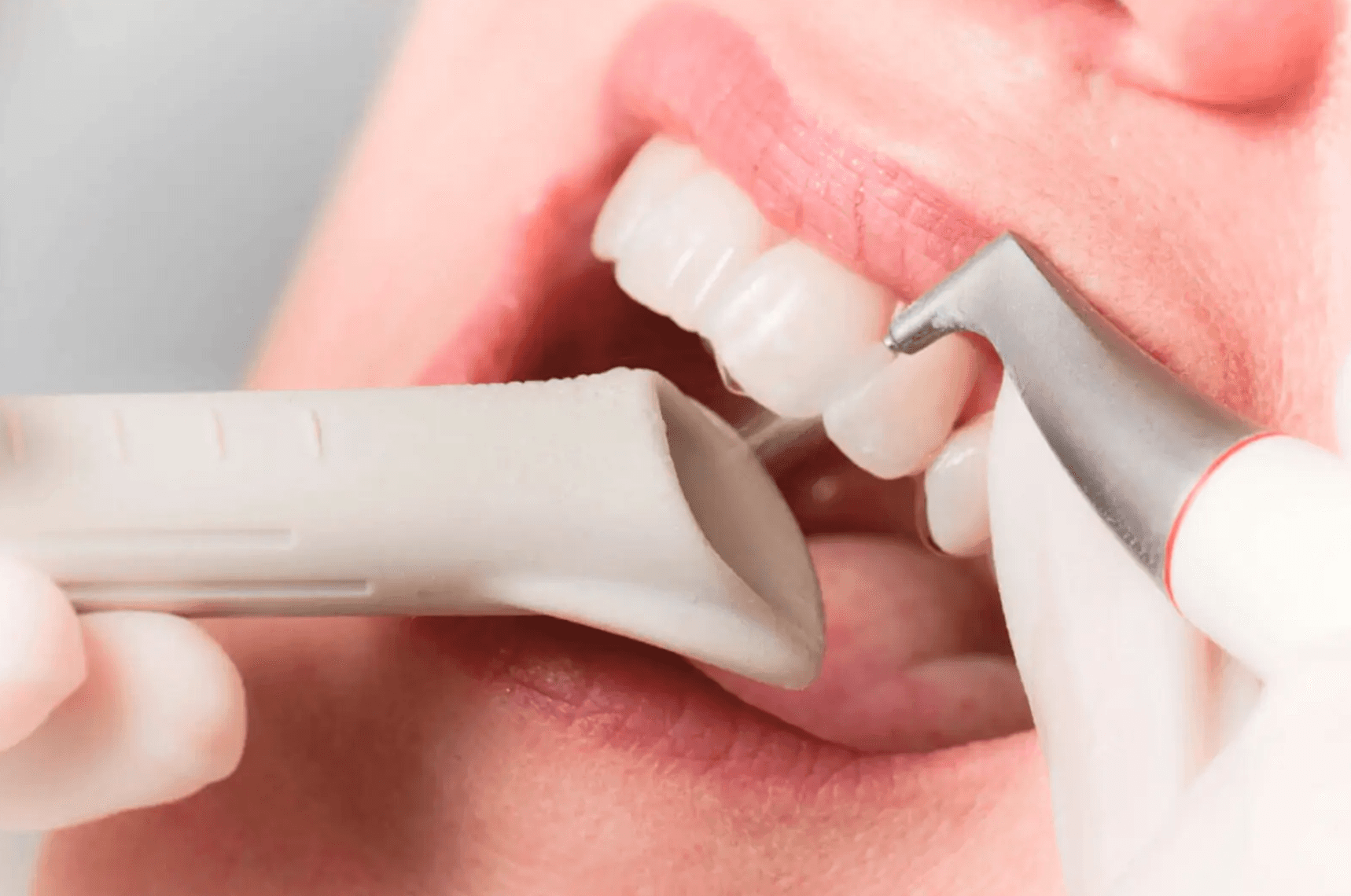 dental clean