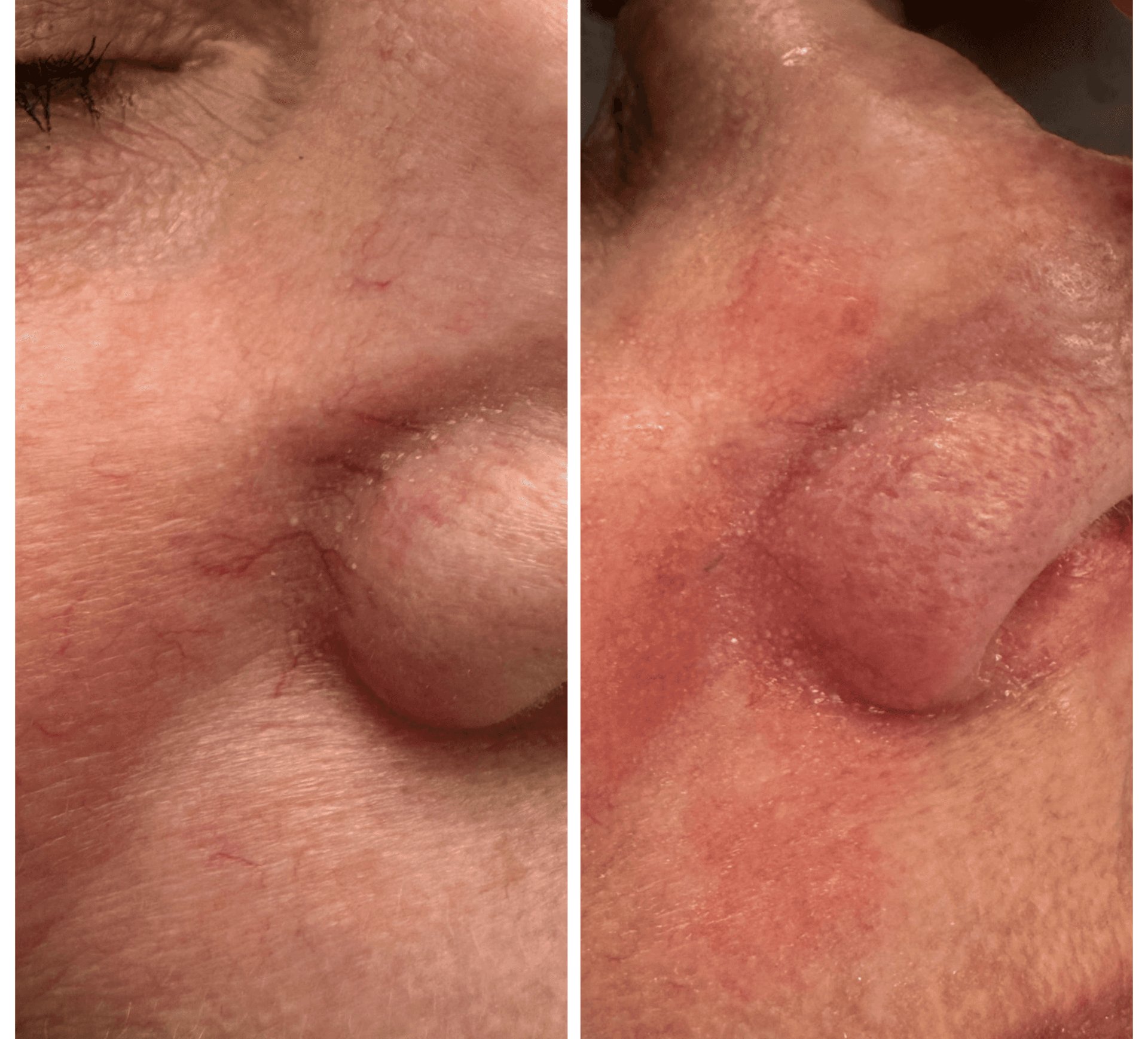Close-up split view of cheek and nose showing redness