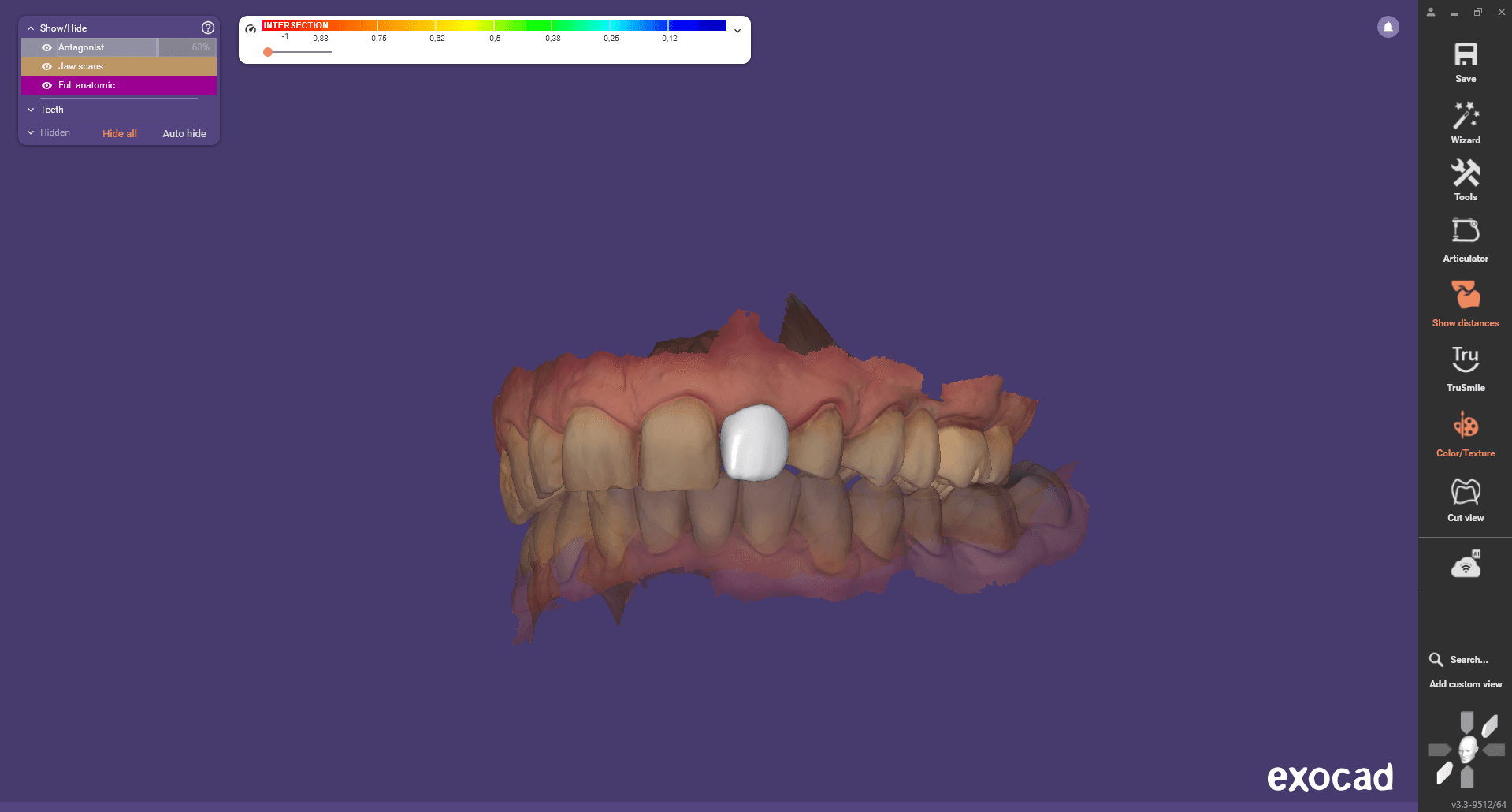 Designsoftware Exocad gebruikt voor waxup tbv implantologie