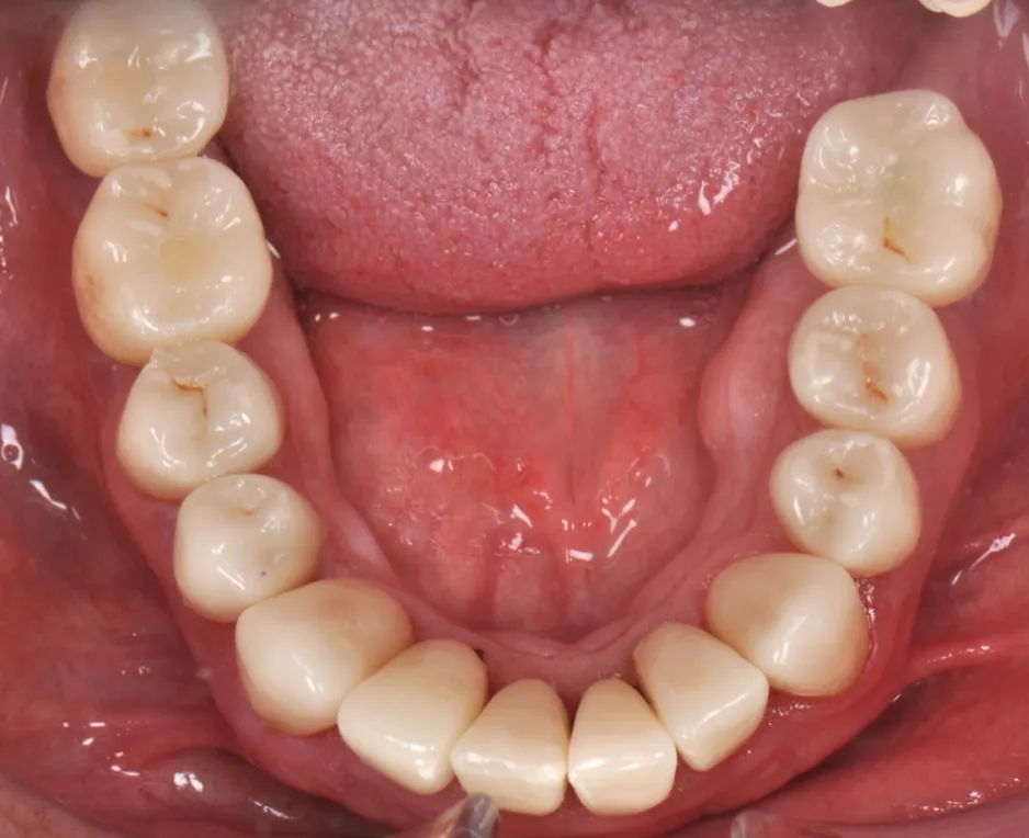 After ortho treatment