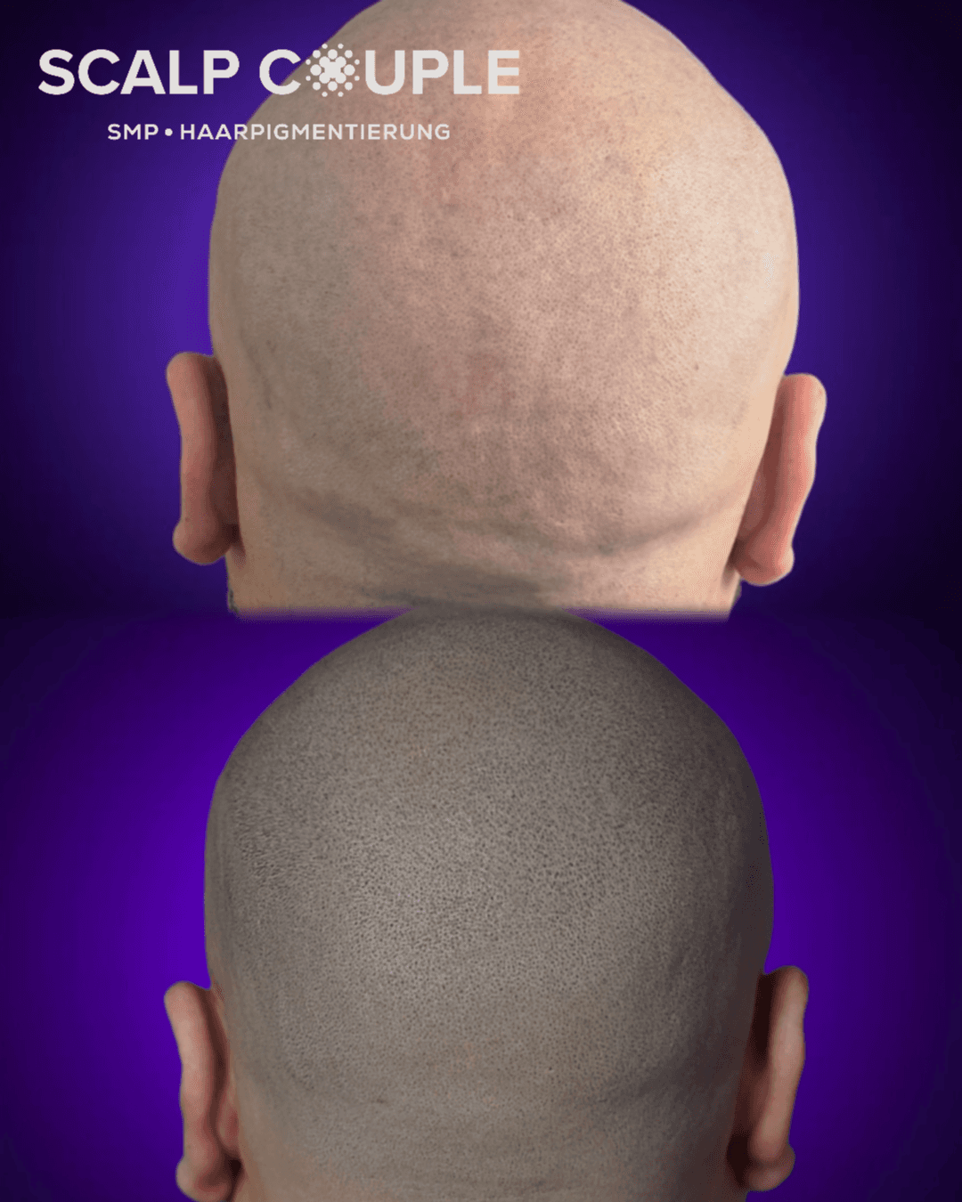 Haarpigmentierung Mann – Narben nach Haartransplantation kaschieren mit SMP | Scalp Couple