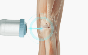 체외충격파가 관절 부위에 전달되는 치료 원리를 나타낸 이미지