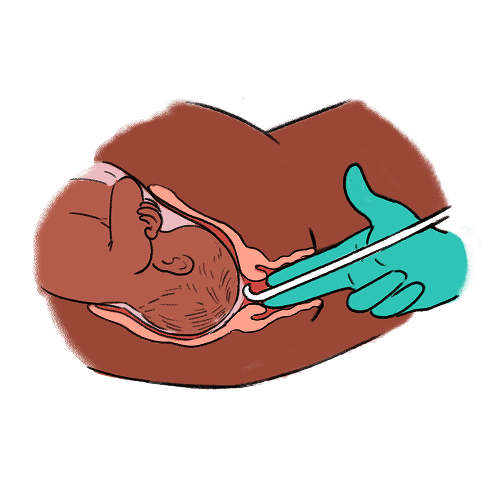 An illustration showing a cross-section of a baby inside the womb, a cervix, a vagina, and two gloved fingers inside the vagina with an amnihook through the cervix breaking the amniotic membrane (waters).