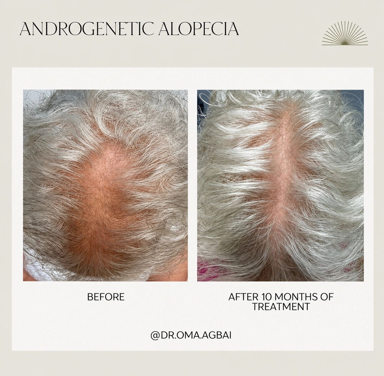 Androgenetic alopecia: before treatment on the left; after 10 months on the right.