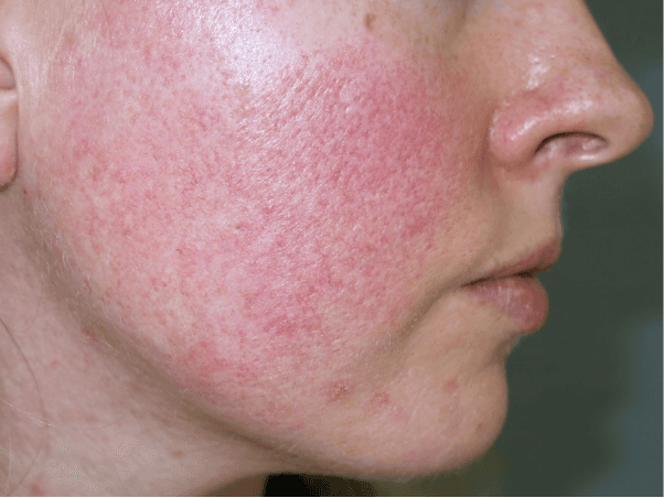 Facial vascular redness with visible capillaries and diffuse redness on the cheeks.