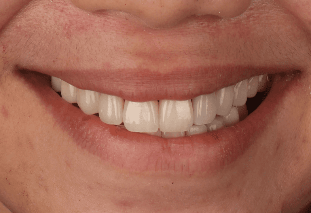 After photo of smile transformation with natural porcelain veneers at Ora Dental Makati