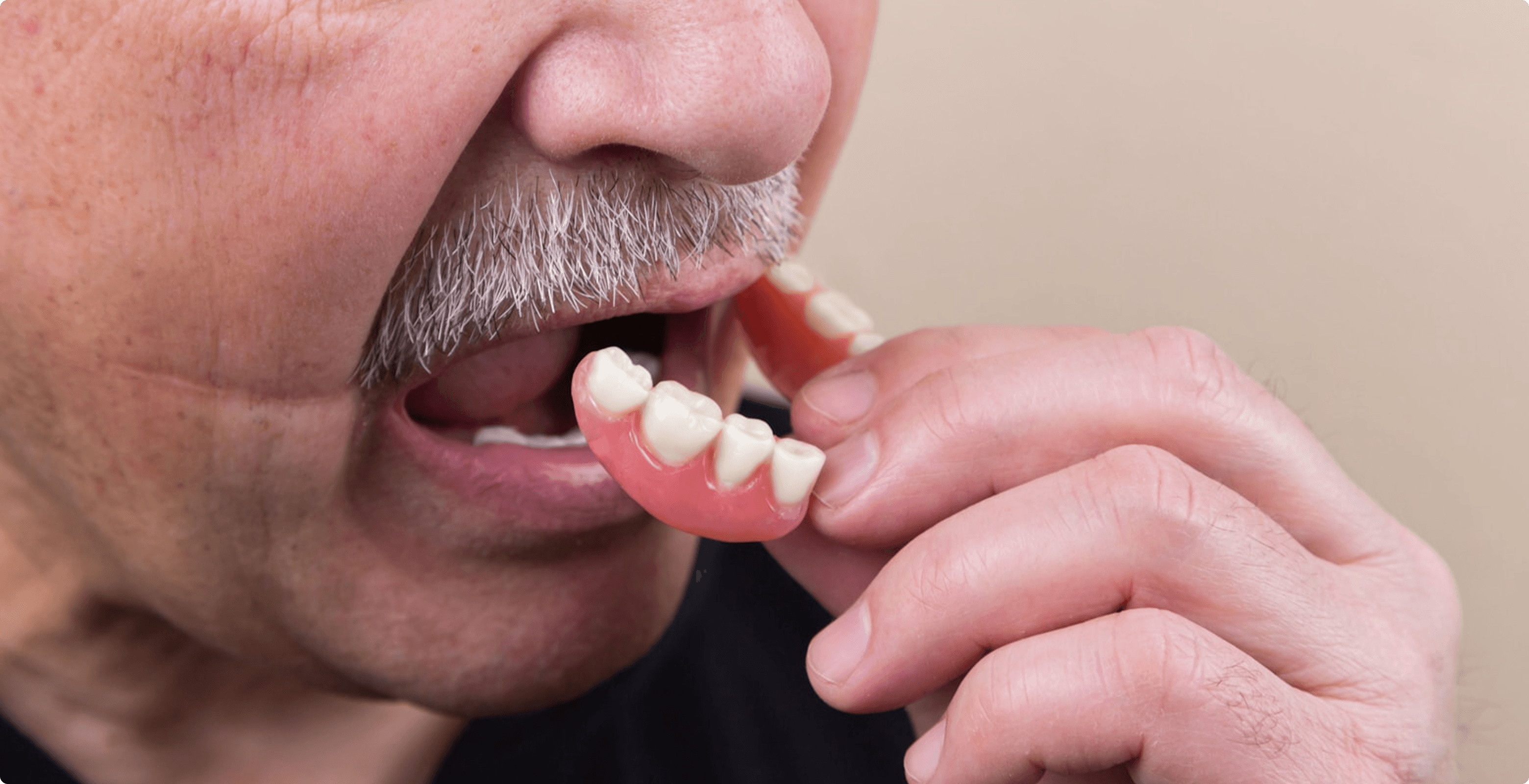Person inserting partial denture into lower jaw with mouth open.