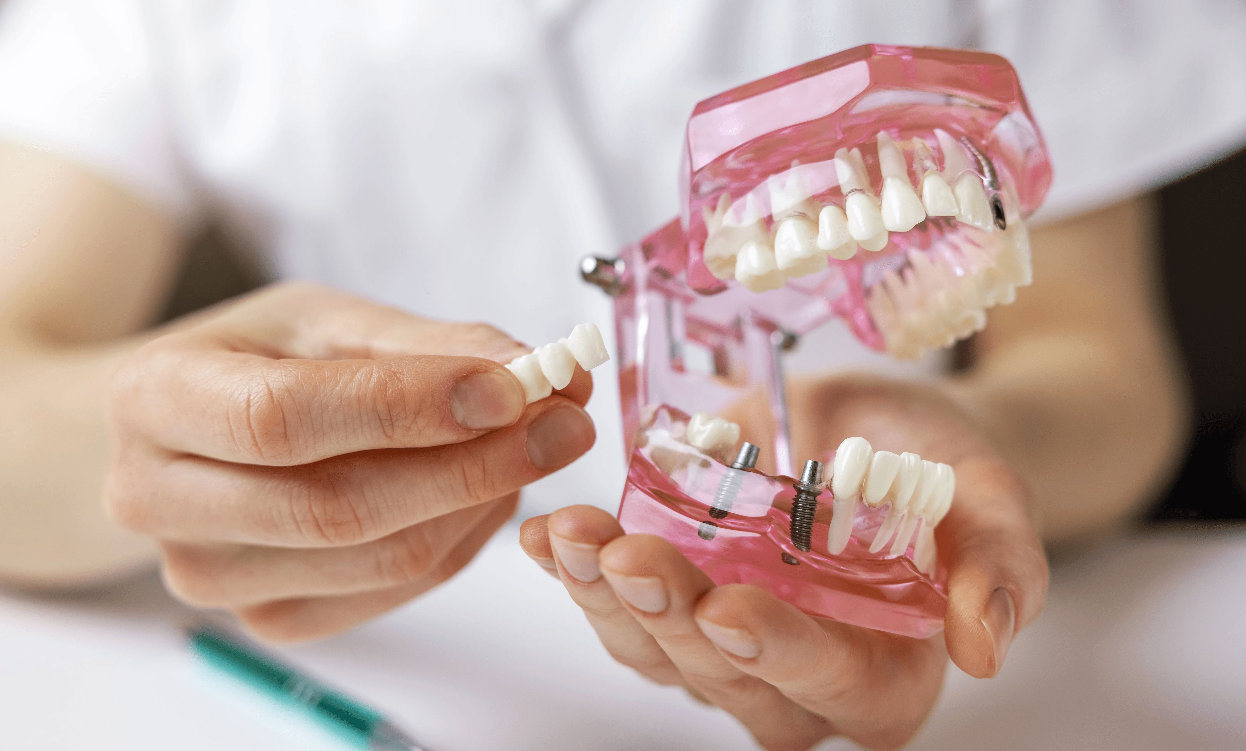 A professional demonstrates the process of placing a dental bridge onto a dental implant model.