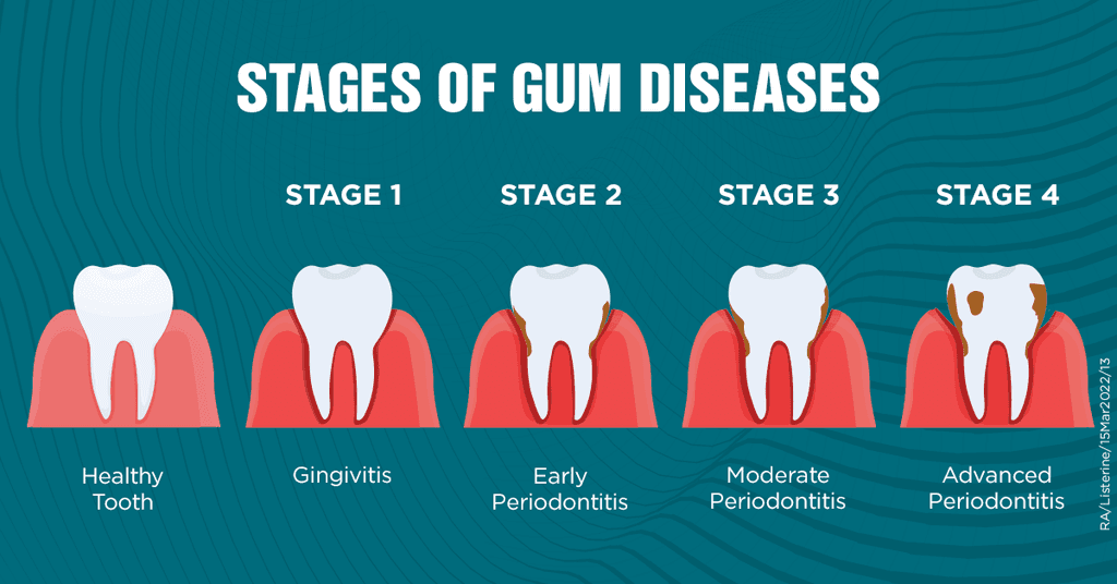 Stages of Gum Disease and Treatment Available at SN Family Dental Milltown & Newark NJ